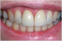 Healthy whitened two front teeth