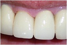 Closeup of tooth after whitening and restorative treatment
