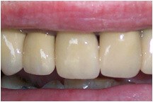 Closeup of three teeth after treatment creating beautiful smile