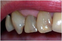 Closeup of three discolored teeth
