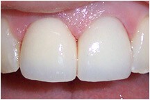 Closeup of tooth after repair