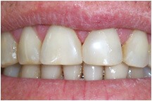 closeup of closed gap between front teeth