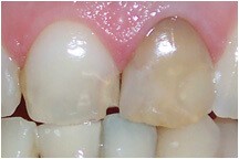 Closeup of yellow damaged tooth