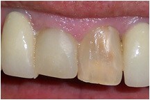 Closeup of darkly colored tooth