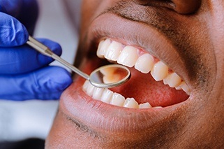 Closeup of patient receiving dental treatment