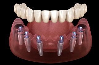 Implant-retained denture on top of six dental implants