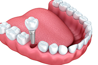 An image of implant supported dentures. 