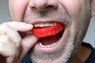 Closeup of patient placing mouthguard