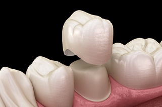 model of a dental crown being placed over a tooth