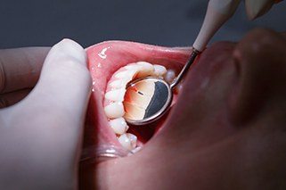 Closeup of patient during dental exam