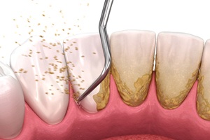 Digital illustration of scaling and root planing in Tullahoma