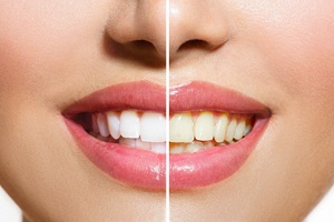 Teeth whitening after and before picture