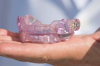 Custom crafted occlusal splints