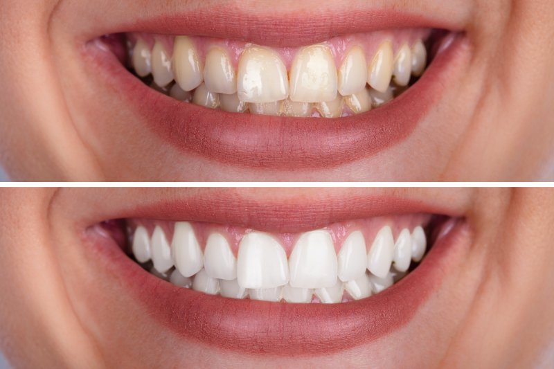 before and after teeth whitening 