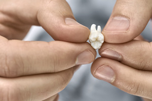 Close-up of hands holding a knocked-out tooth