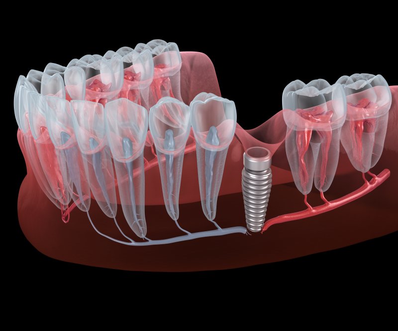 Illustration of dental implant in gum tissue